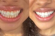 Teeth whitening solution